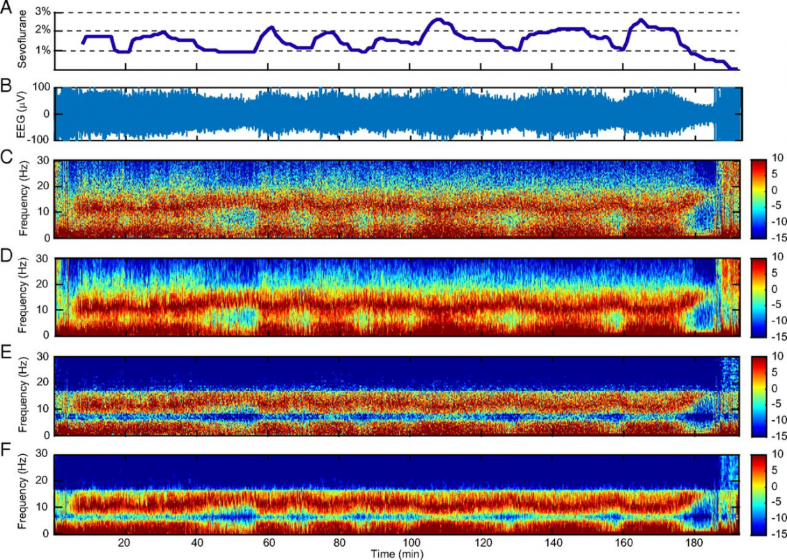 New-algorithm-time-frequency-analysis-brainwaves-MIT-00.png
