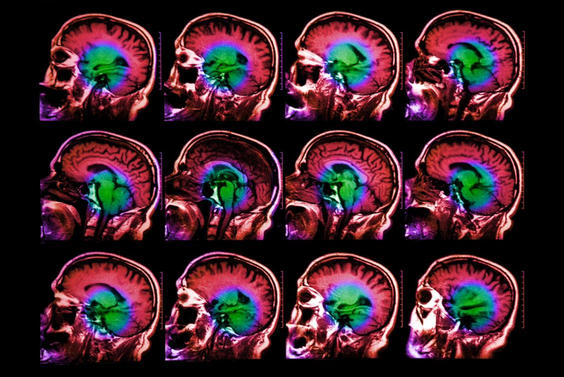 A series of brain scans