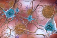 Study explains how a rare gene variant contributes to Alzheimer’s disease