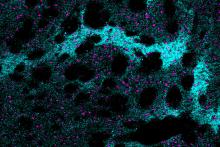 One more clue to brain changes in Huntington’s disease