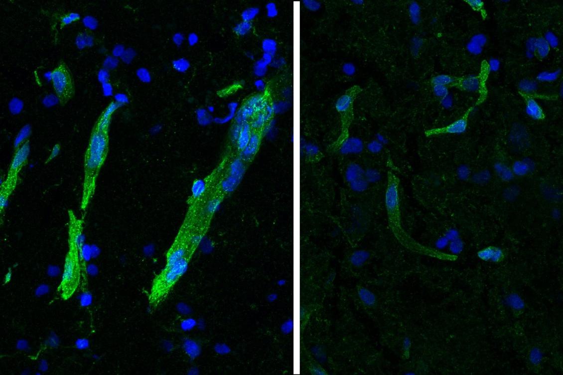 Study: Movement disorder ALS and cognitive disorder FTLD show strong molecular overlaps Study: Movement disorder ALS and cognitive disorder FTLD show strong molecular overlaps