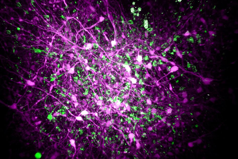 Rett syndrome study highlights potential for personalized treatments