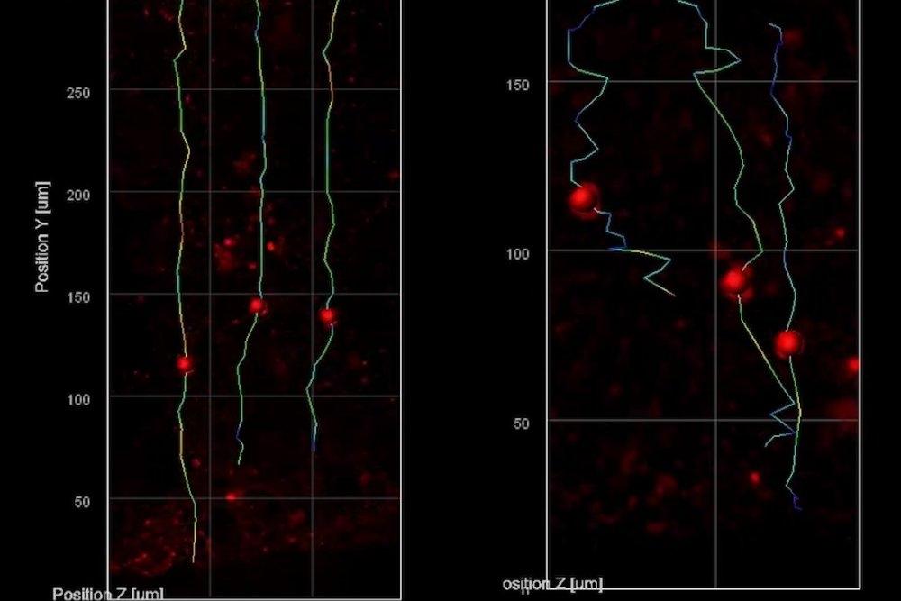 Advanced imaging reveals mired migration of neurons in Rett syndrome lab models Advanced imaging reveals mired migration of neurons in Rett syndrome lab models