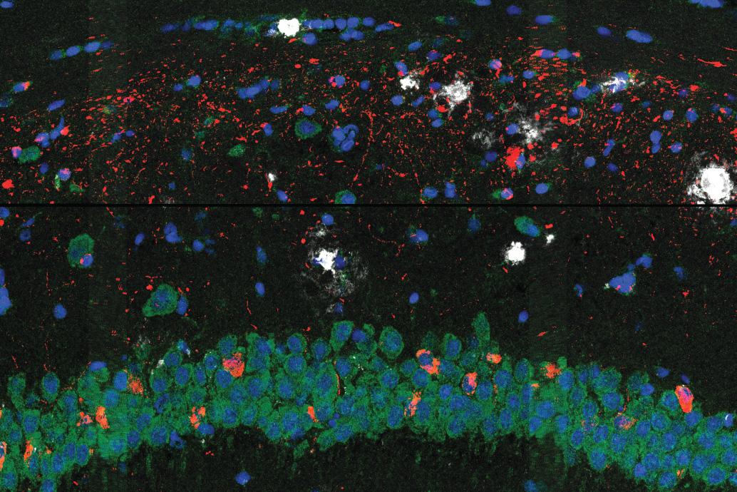 Researchers map brain cell changes in Alzheimer’s disease Researchers map brain cell changes in Alzheimer’s disease