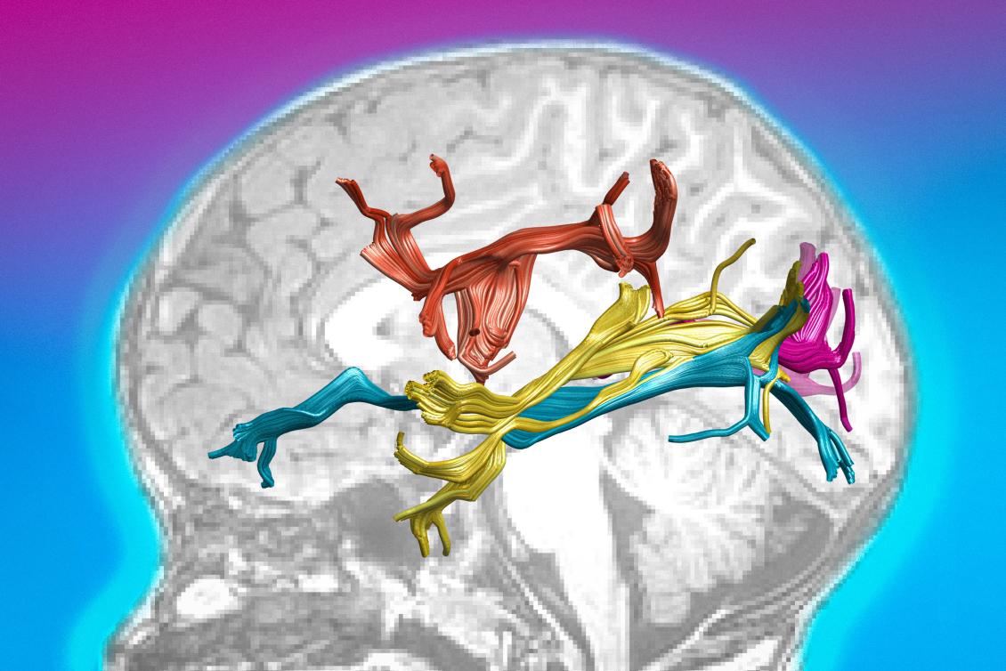 Scientists discover anatomical changes in the brains of the newly sighted Scientists discover anatomical changes in the brains of the newly sighted