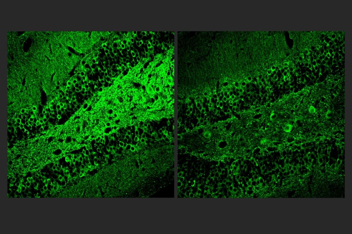 Molecule reduces inflammation in Alzheimer’s models Molecule reduces inflammation in Alzheimer’s models