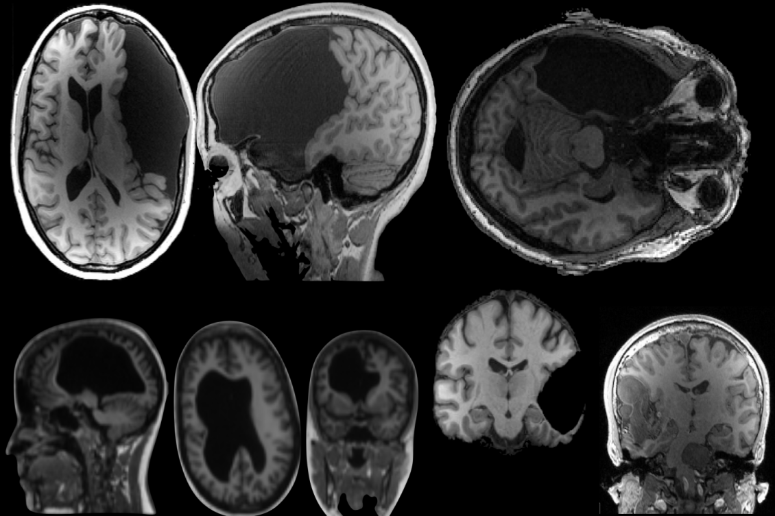 Studies of unusual brains reveal critical insights into brain organization, function Studies of unusual brains reveal critical insights into brain organization, function