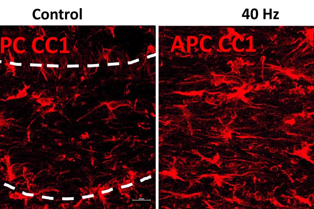 Study reveals ways in which 40Hz sensory stimulation may preserve brain’s “white matter”