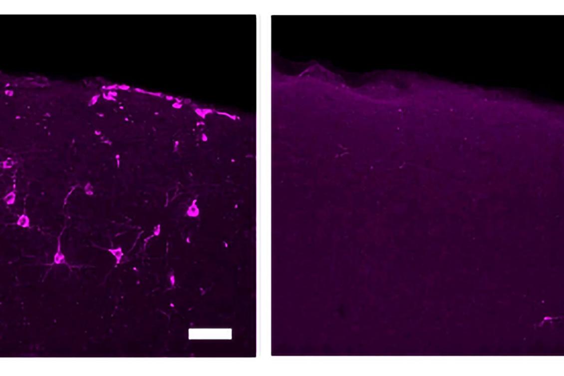 How a mutation in microglia elevates Alzheimer’s risk How a mutation in microglia elevates Alzheimer’s risk