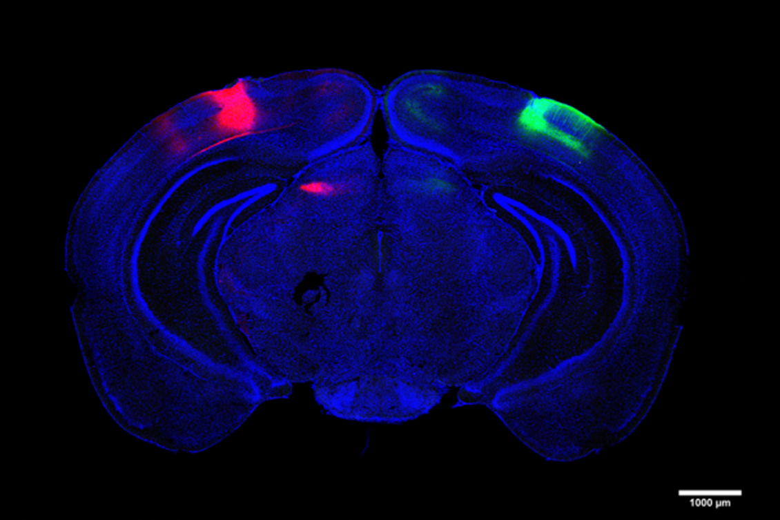 When Alzheimer’s degrades cells that cross hemispheres, visual memory suffers