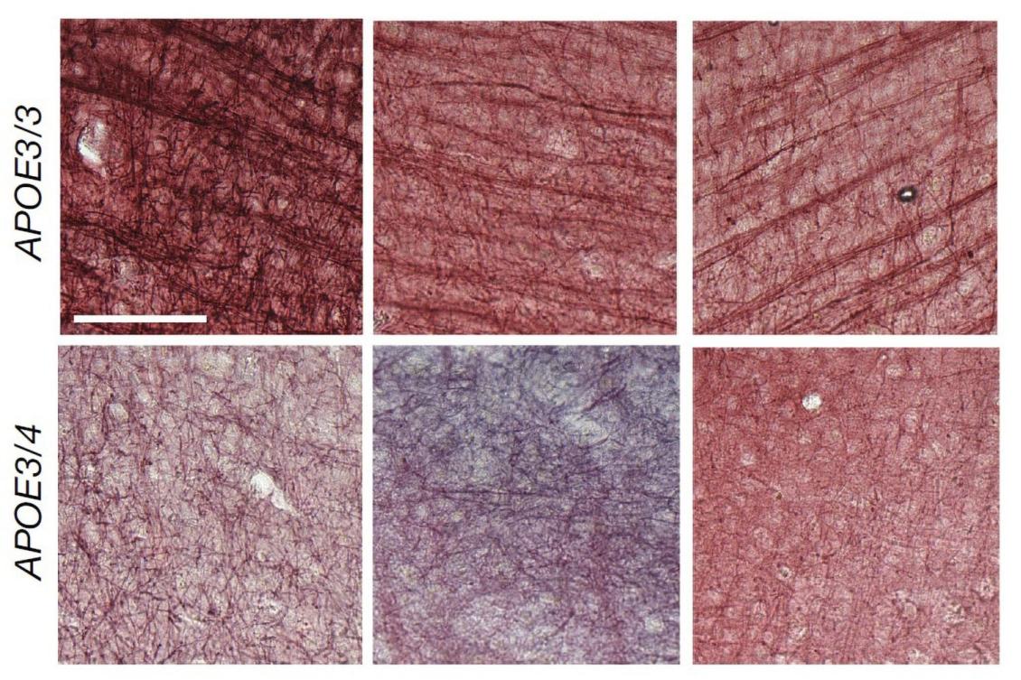 Alzheimer’s risk gene undermines insulation of brain’s “wiring”